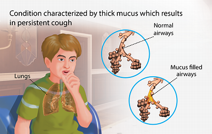 Cystic Fibrosis